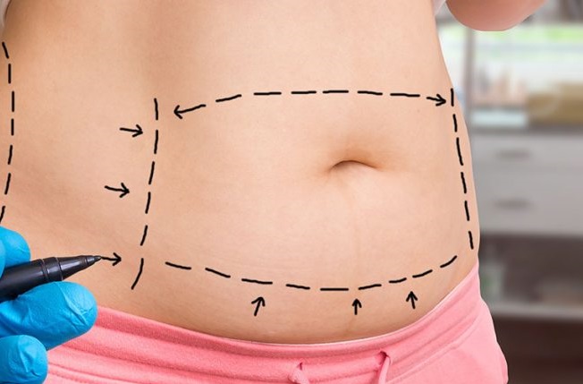 Plástica na barriga em Rio das Ostras