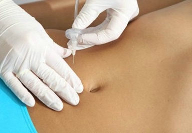 Carboxiterapia em Macaé