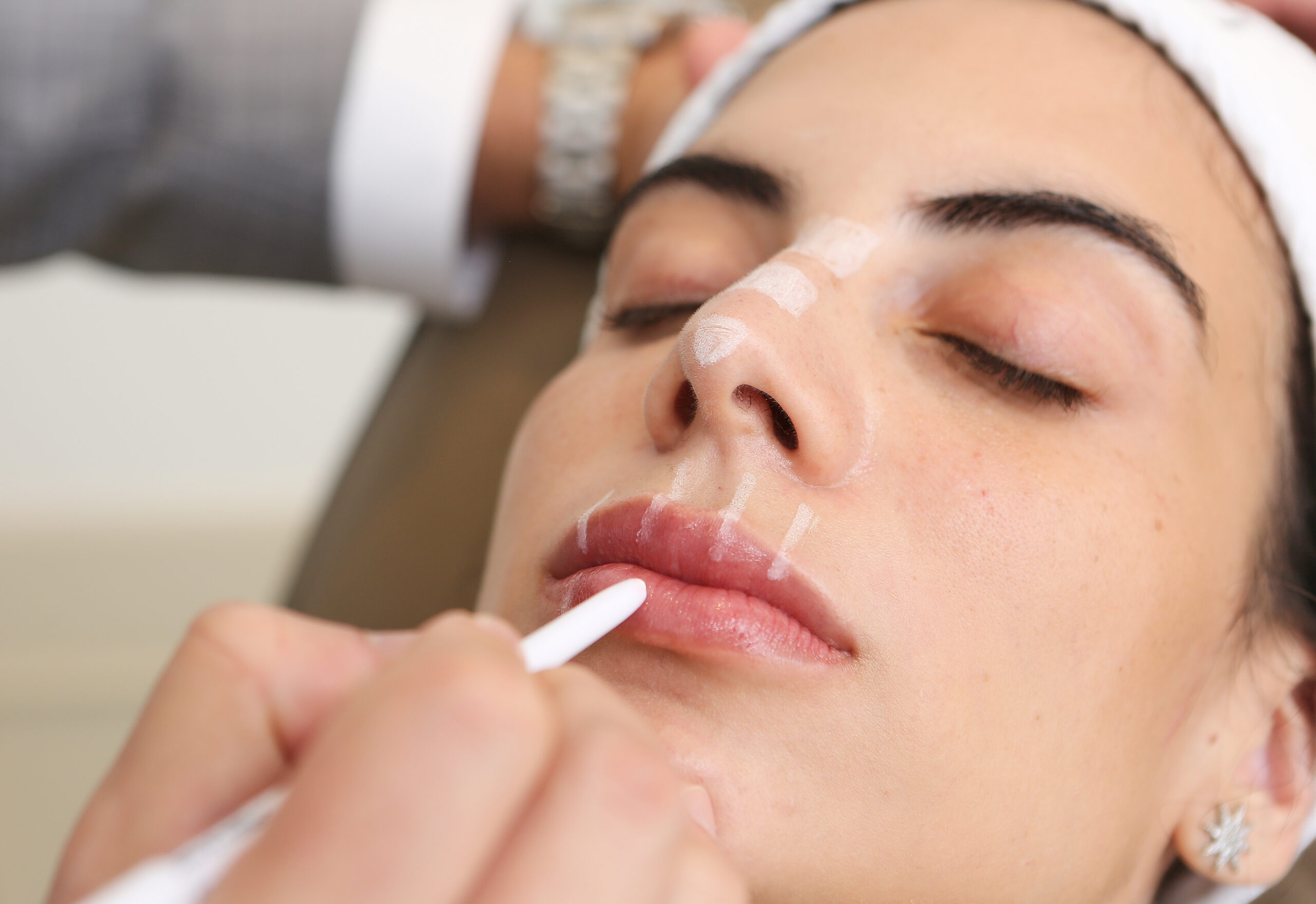 PREENCHIMENTO FACIAL COM ÁCIDO HIALURÔNICO