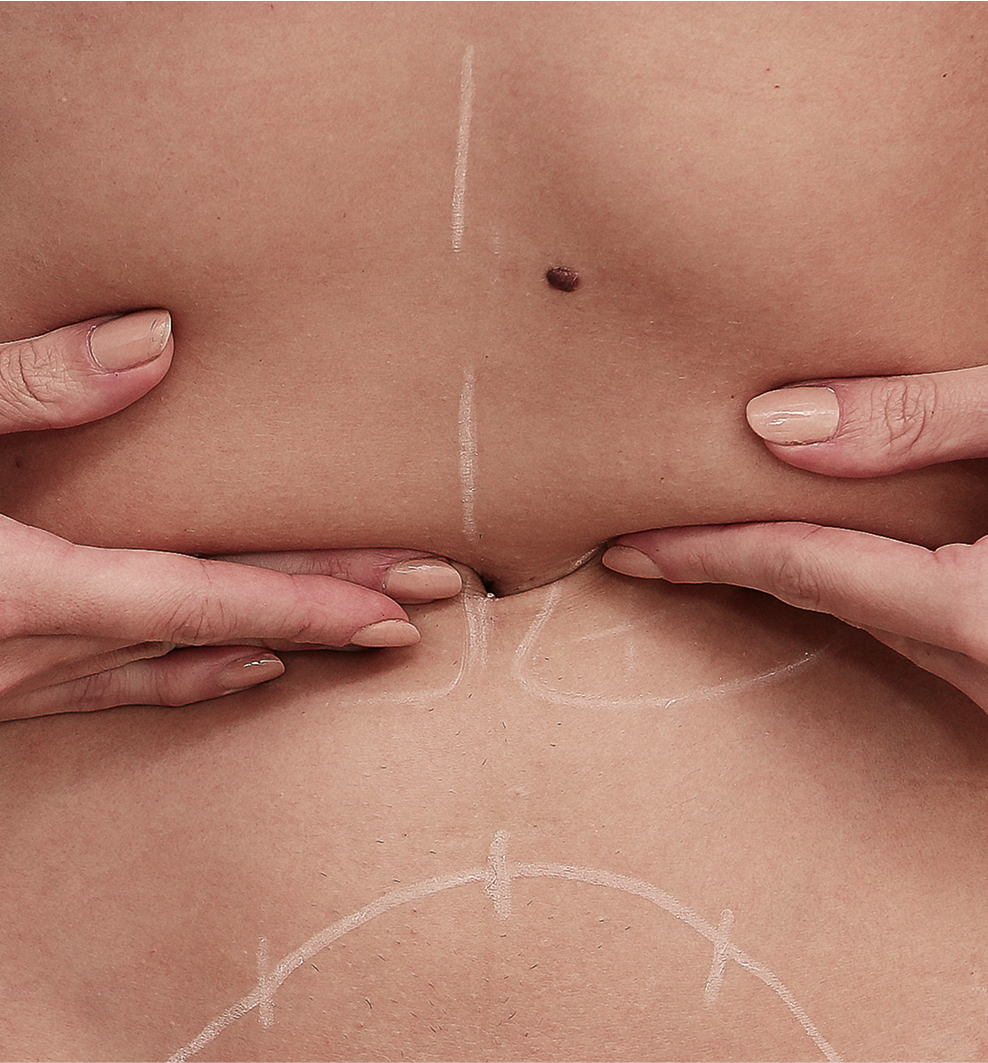 MINIABDOMINOPLASTIA