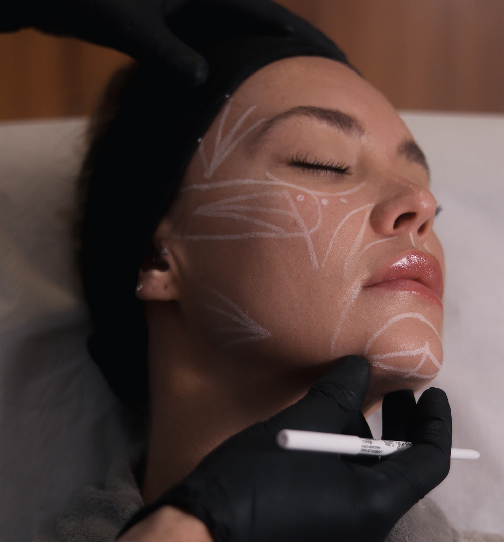 PREENCHIMENTO FACIAL COM ÁCIDO HIALURÔNICO