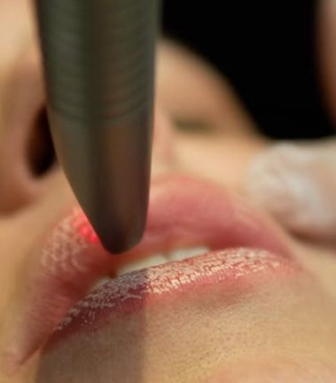 DEPILAÇÃO A LASER FOTONA
