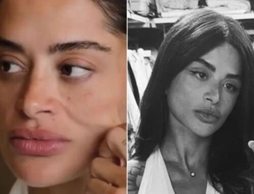 Lifting facial aos 38 anos? Cirurgia de Aline Campos reacende debate sobre idade ideal; entenda